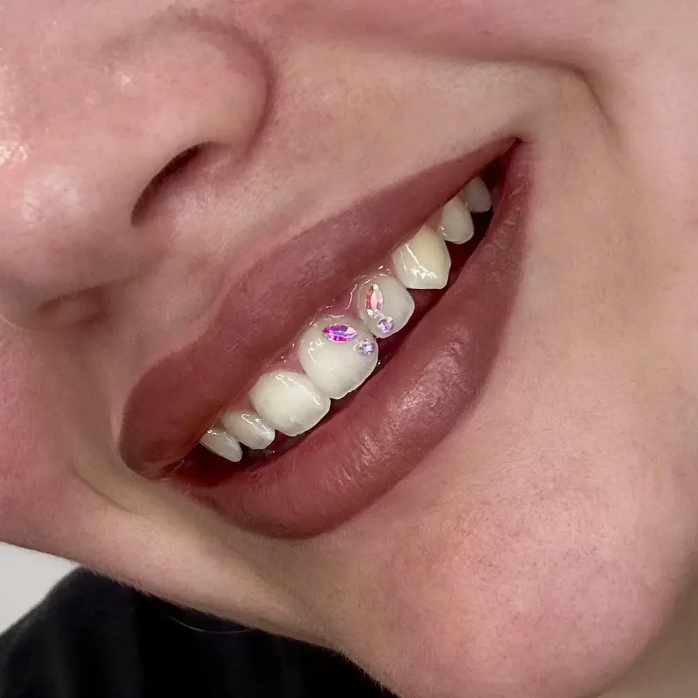 Gemas dentales - resultado 1