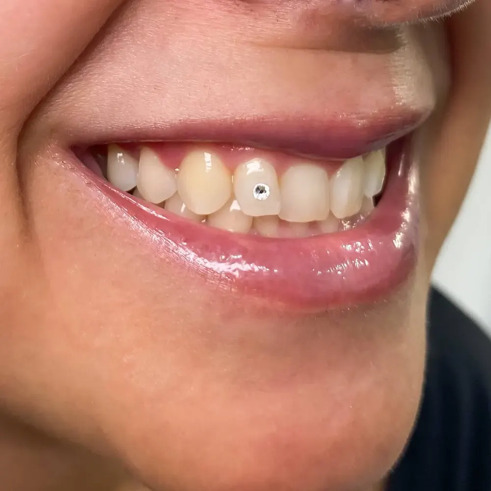 Gemas dentales - resultado 2