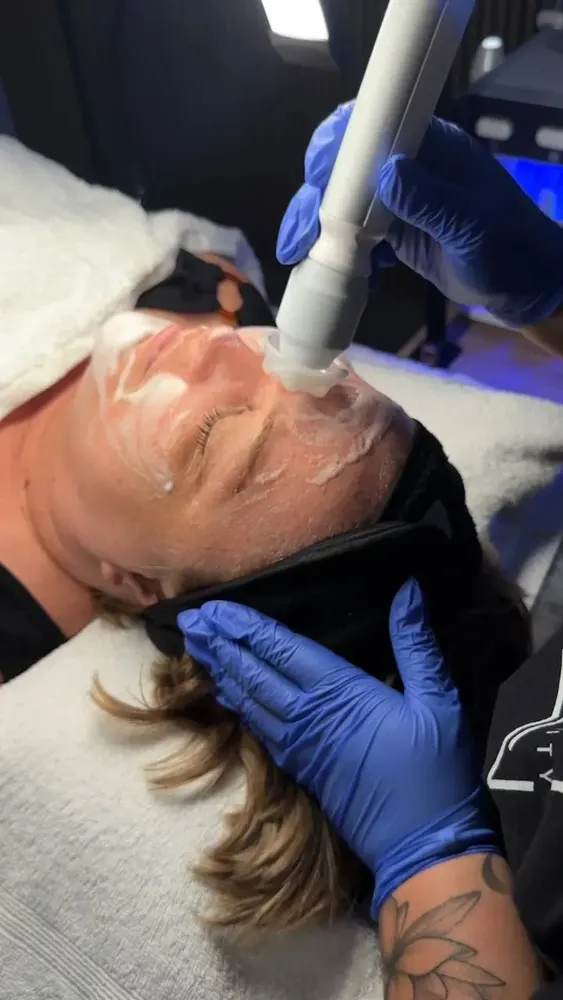 Hydrafacial - resultado 1