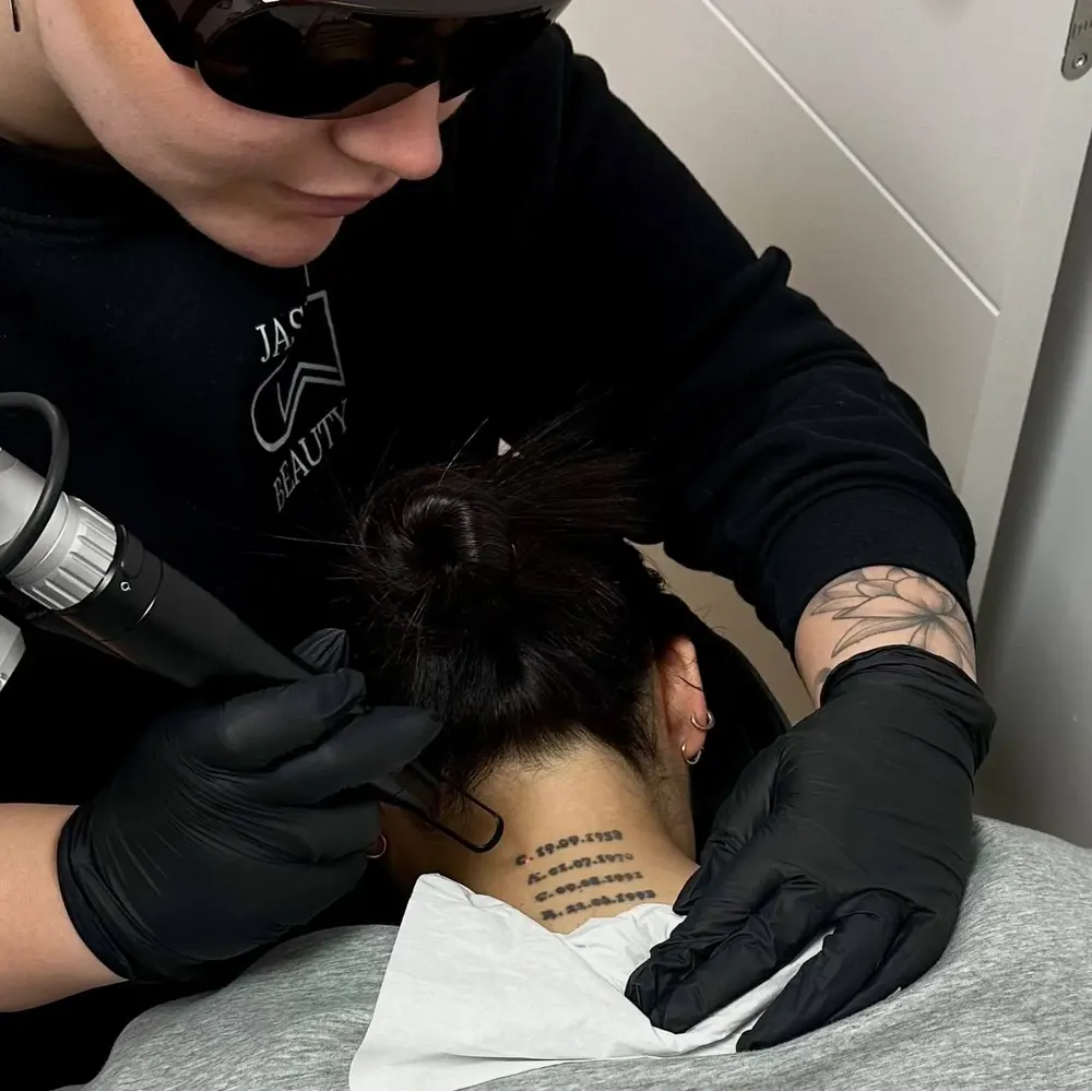 Eliminación de tatuajes - resultado 1